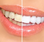 Teeth-Whitening