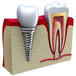 Advantages and Disadvantages of Dental Implants in Queens NY