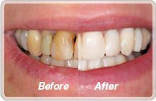 Discolored Teeth? Cosmetic Dentistry Services in St George, UT can Brighten Them