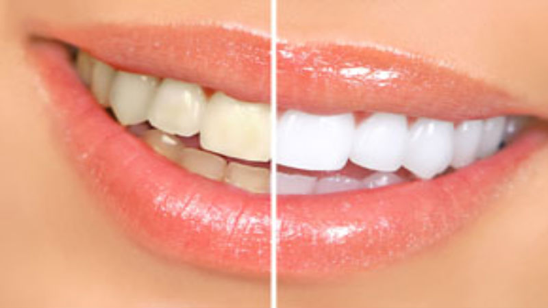 Let’s Clear Up Some Cosmetic Dentistry Myths